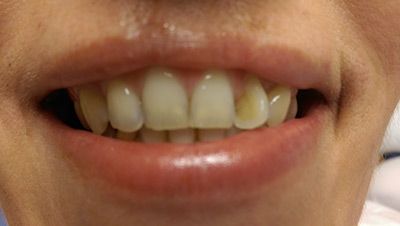 Fogmegtartó kezelés előtti fogsor képe