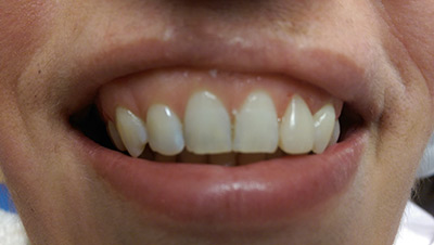 Fogmegtartó kezelés utáni fogsor képe