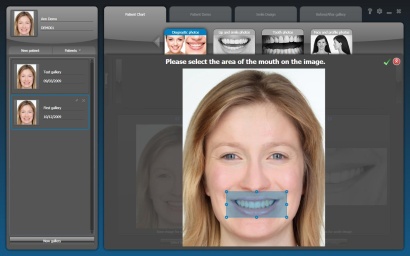 Smylist szoftver képernyőképe, mosolytervezés